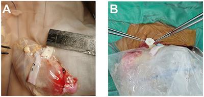 Super-Minimal Incision Technique in Pediatric Kidney Transplantation: A Paired Kidney Analysis